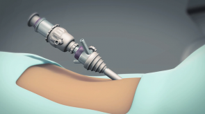 机器人前列腺切除术医疗